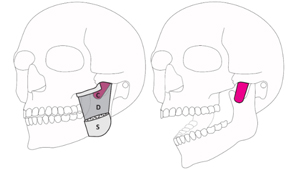 Musculus masseter pars coronidea